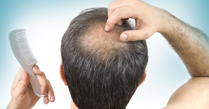 Alopecia, tratamiento con Factores Crecimiento (PRGF)
